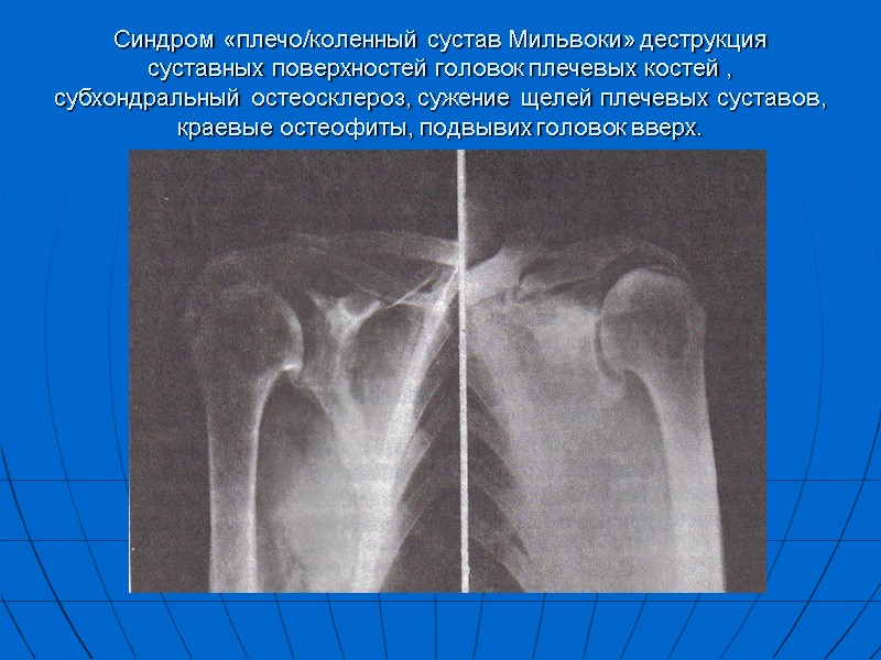 Синдром «плечо/коленный сустав Мильвоки» деструкция суставных поверхностей головок плечевых костей , субхондральный остеосклероз, сужение